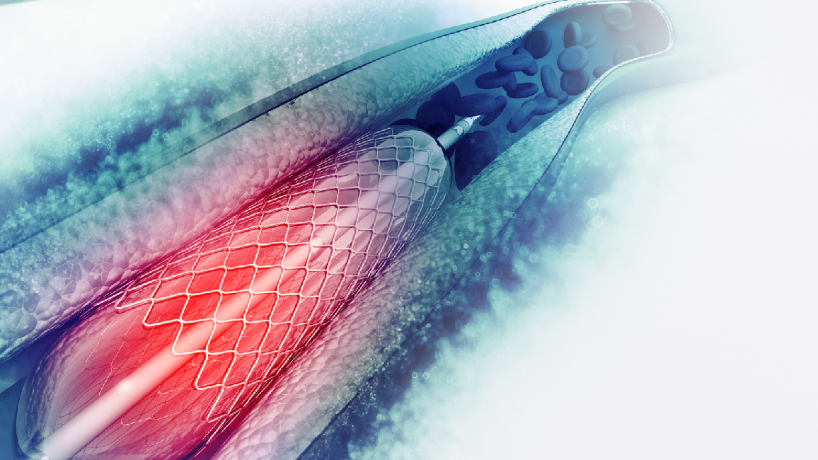 clot retrieval